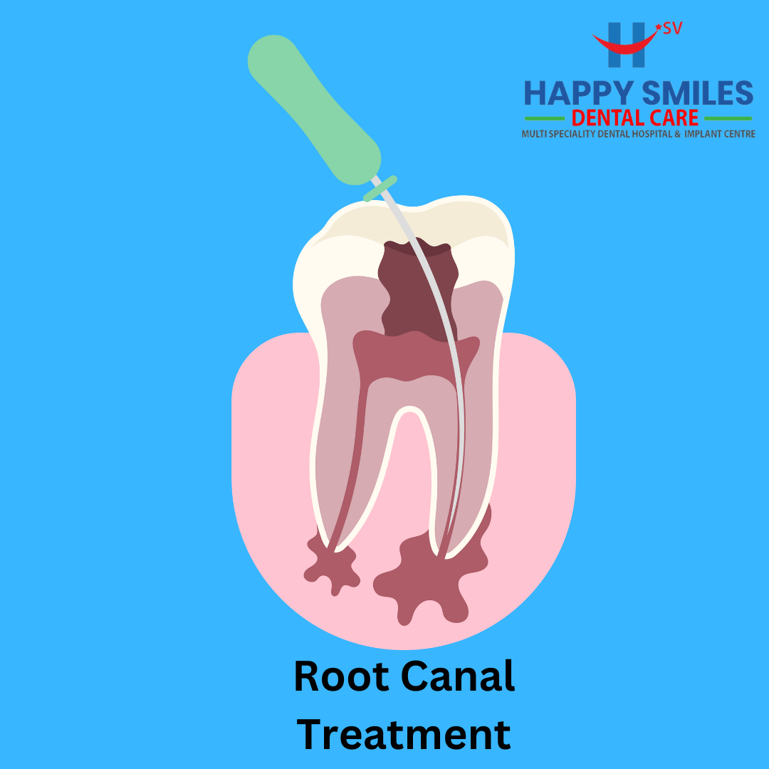 Root canal treatment in hyderabad