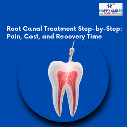 Root Canal Treatment Step-by-Step